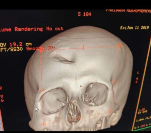 DrRudrajitSinha's tweet photo. Skull radiograph of a junior doctor in West Bengal, India. Violence against doctors in India goes unabated and unhindered. Junior doctors being the most vulnerable. Help! @WHO @UN @MedSansFrontr @hrw @TheLancet @NEJM @nature 

#paribaha #health #Healthcare #india https://t.co/lRFXLtF6Qv