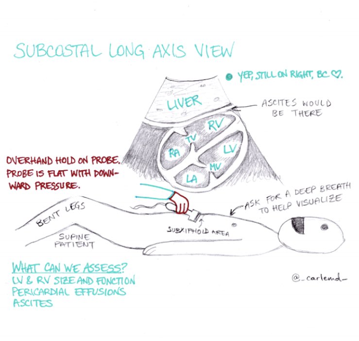 I’ve been doing an NYU POCUS course and it’s been AWESOME. Here are some notes I took on cardiac US views. Spoiler alert, getting good cardiac windows IRL is so damned tricky...
#POCUS #FOAMed #graphicmedicine