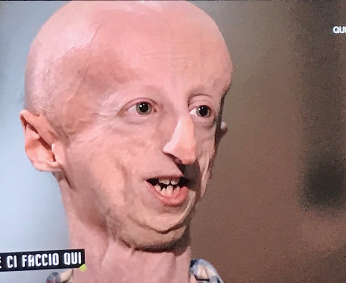 La bellezza dell’intelligenza, la bellezza dell’anima ❤️#SammyBasso #Progeria #CheCiFaccioQui #DomenicoIannacone #rai3 ⁦@SammyBasso⁩