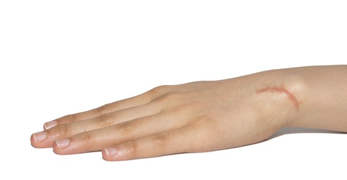 We've performed countless #ScarTreatments on patients in the Boise area. bit.ly/2pBpdnt