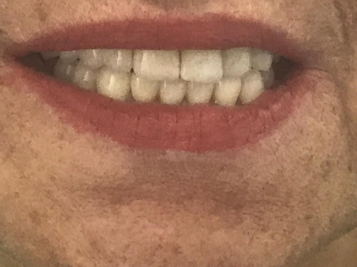 GarciaClinica's tweet image. Hoy mostramos el antes y después de una rehabilitación completa con Zirconio. 
Recordad, más vale ser previsores. 
No olvidés pedir vuestra cita previa con Clínica Dra. Elena García:

Tel. 952 85 85 00 - WhatsApp 674 16 42 00
#klockner #implantes #seguridad #confianza