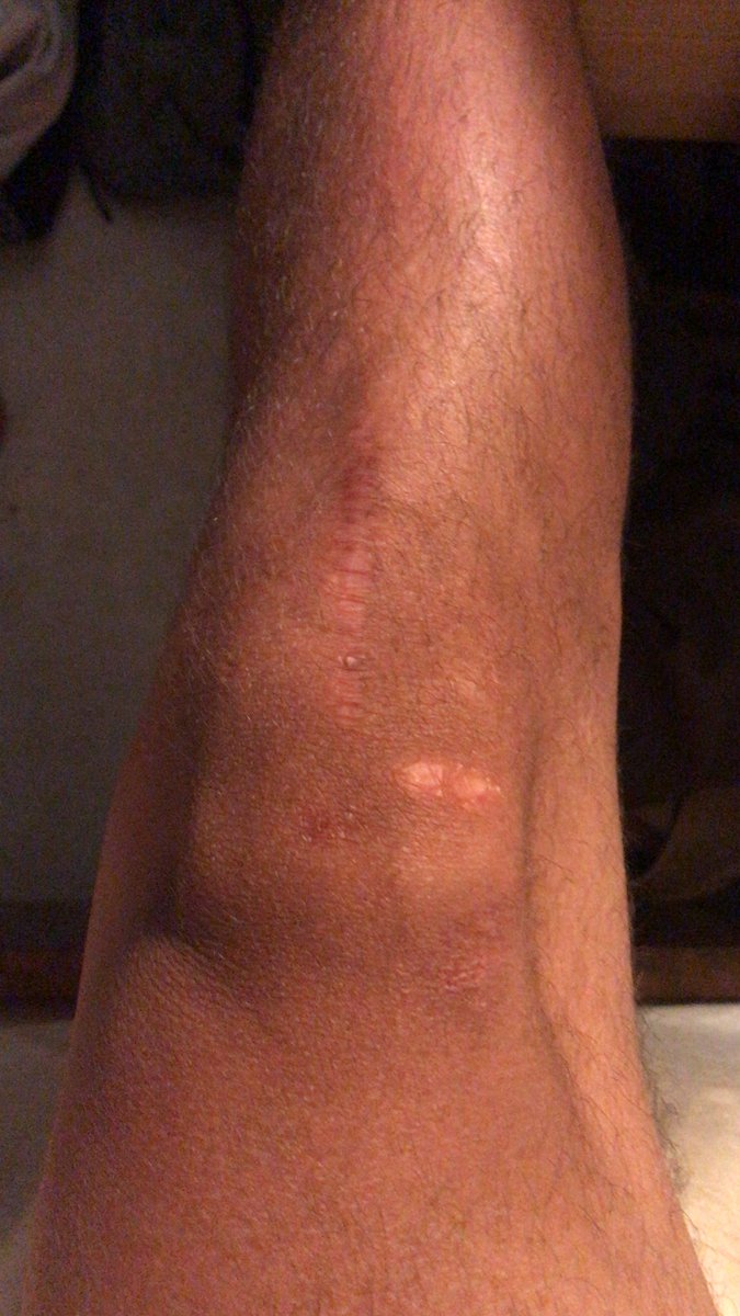 TahoeOtto's tweet photo. Goodbye old friend, the grass is greener on the other side #3rdkneesurgery #sameknee #cantwaittorecover https://t.co/rdzonczdyp