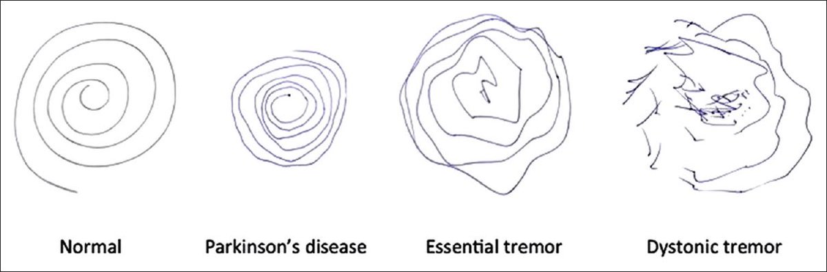 GregYoudan's tweet photo. Not all tremors are  #ParkinsonsDisease 

Tremor is an involuntary, somewhat rhythmic, muscle contraction/ relaxation involving oscillations or twitching movements.  

Spiral drawings are often used to clinically assess tremor. 

#EssentialTremor #Dystonia #MovementDisorders https://t.co/z25bLMrUxs
