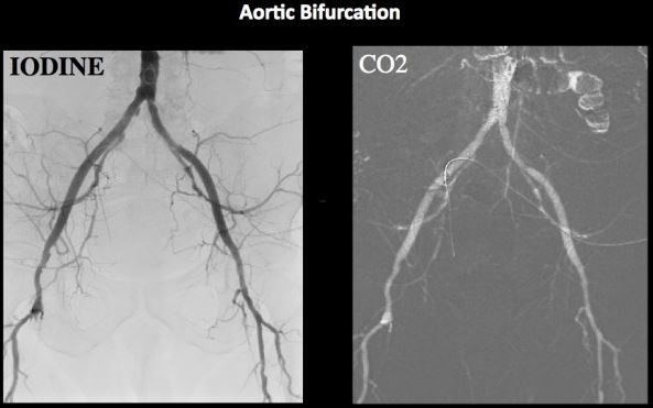 Join the discussion regarding CO2 Angiography over on LinkedIn.
linkedin.com/feed/update/ur…
#angiodroid #theCO2injector #CO2angiography #acda #live #annualmeeting #livecase #medicalimaging