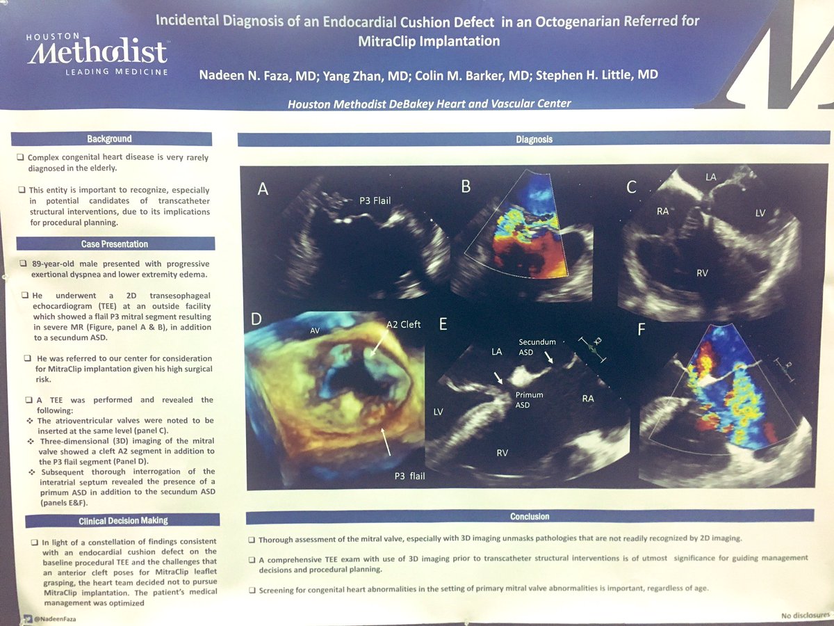 💥 Check out our poster (P2-172)- Incidental Diagnosis of an Endocardial Cushion Defect in an Octogenarian! #ASE2019 #ASEValves  #ACCFIT #MitraClip #Cardiotwitter #EchoFirst #iecho
