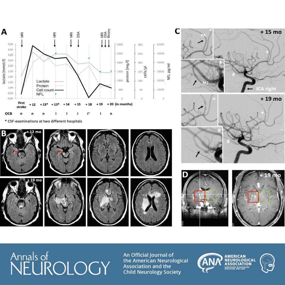 ANAneurology's tweet photo. #ANAJournalHighlight: This study in Annals of Neurology suggests an urgent need for novel therapeutic approaches that embrace the complexity of disease to combat cognitive decline in old age https://t.co/twhIS9rbqo https://t.co/EZ3A9eVVQr
