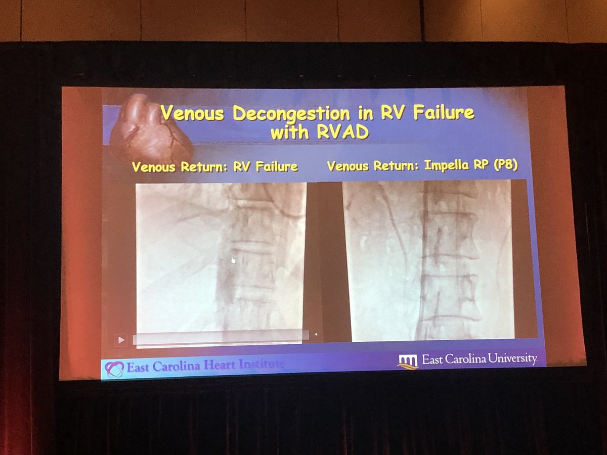 shonmd's tweet photo. Don’t forget the right ventricle. Great debate and points by Dr. Lynn Morris @EastCarolina #C32019 @C3_Academy #impellaRP #waronshock https://t.co/ruMqjzwxgB