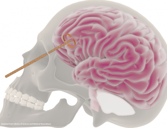 NZScienceLearn's tweet photo. After work in Dunedin tonight -THE HISTORY OF FRONTAL LOBOTOMY (Is it just us but we get images of an evening of gothic horror...)
https://t.co/fZ1D1ZRCGV
#STEMnz #Lobotomy @OtagoMuseum @BrainResearchNZ @neurosquared @Lukeslifeonline @BlaiseSciComm @JasoniCL https://t.co/mTCb8MvPFm