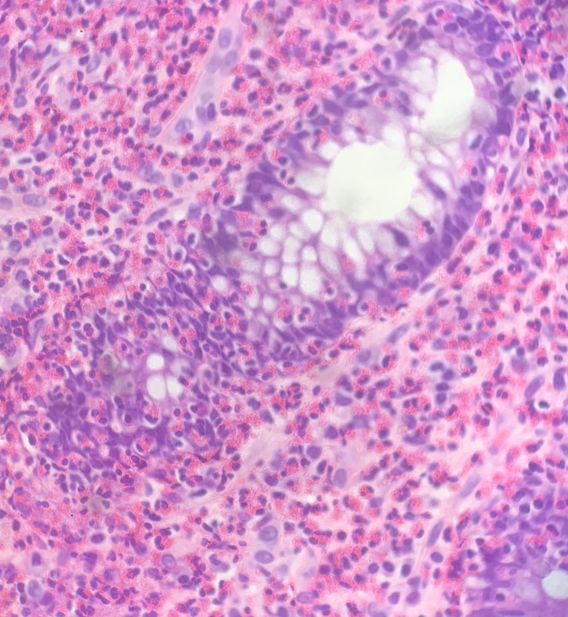 robdgol's tweet photo. Deciding if there are increased numbers of eosinophils in a GIT biopsy is often a challenge but not here!#GIpath https://t.co/hFTGFXKLiT