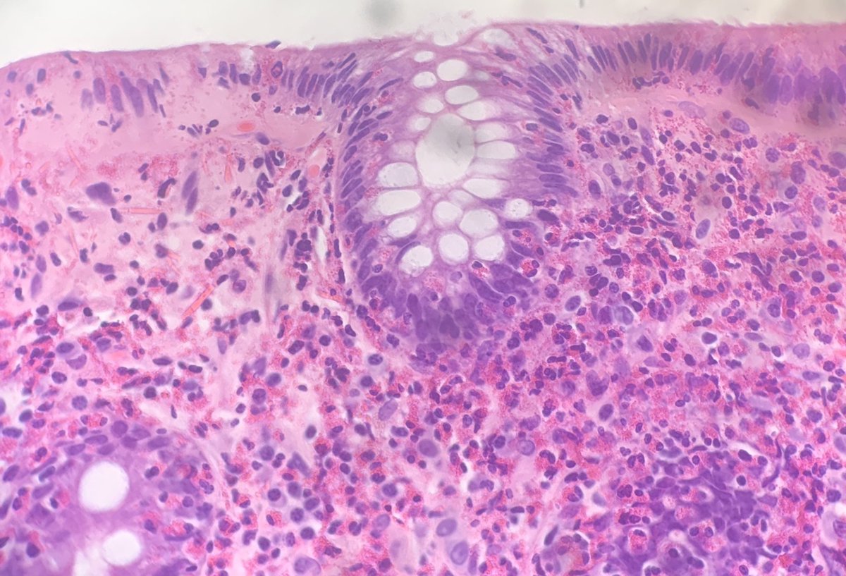 robdgol's tweet photo. Deciding if there are increased numbers of eosinophils in a GIT biopsy is often a challenge but not here!#GIpath https://t.co/hFTGFXKLiT
