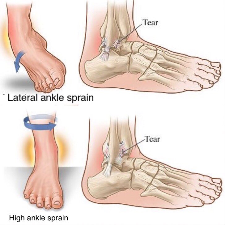 (high ankle sprain), suffering a high grade lateral ankle sprain (low ankle ...