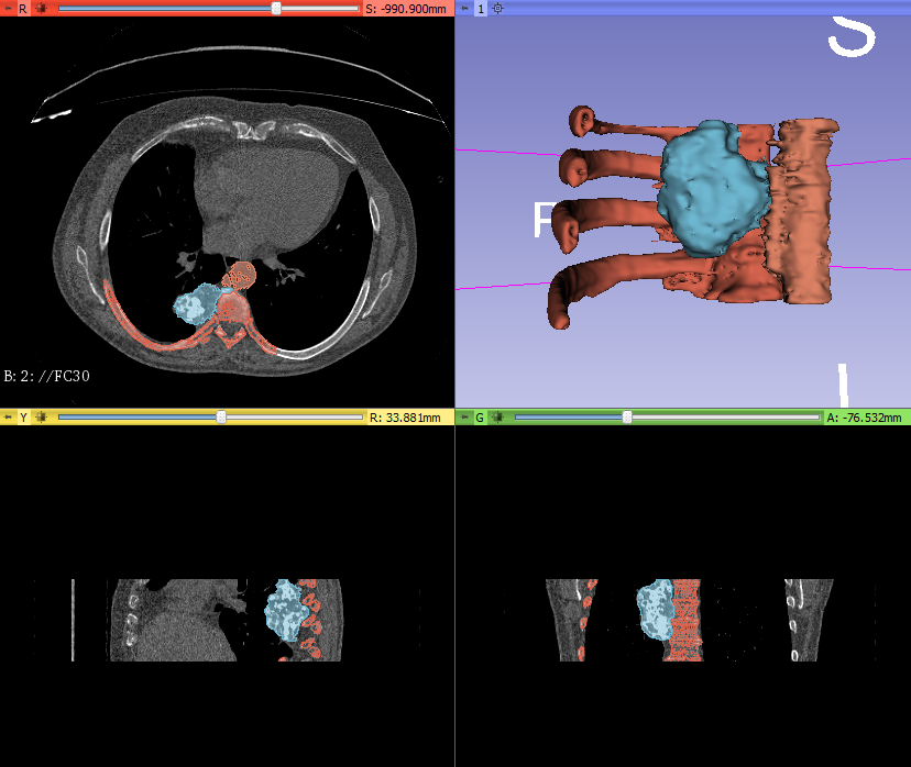 3d_maranon's tweet photo. 3D Model of an osteosarcoma(red) connected to the T7 and the aorta(withe) next to them. The tumor will be extracted in two phases and the model will help the surgeon @LydiaMediavilla to plan the procedure. #HospitalMarañon3D FabLab team: @rupermac @calvoharo_ja @diegotrap @kn_ord https://t.co/UlZra7Gxr4
