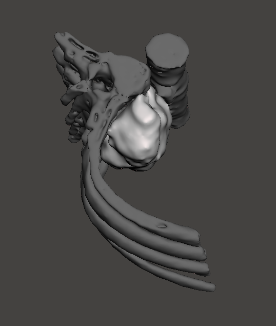 3d_maranon's tweet photo. 3D Model of an osteosarcoma(red) connected to the T7 and the aorta(withe) next to them. The tumor will be extracted in two phases and the model will help the surgeon @LydiaMediavilla to plan the procedure. #HospitalMarañon3D FabLab team: @rupermac @calvoharo_ja @diegotrap @kn_ord https://t.co/UlZra7Gxr4