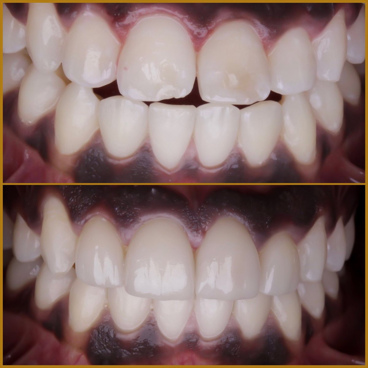 igniteDDS's tweet photo. Hereโs one for our @TheAACD friends. Our founder, Dr. David Rice in conjunction with great materials and technology helped this young man ๐. @PattersonDental @Ivoclar_US @DentsplySirona #Smile #teeth #veneers #healthandwellness #lifechanging #dentistry #ignitedds https://t.co/QWKgViEkZy