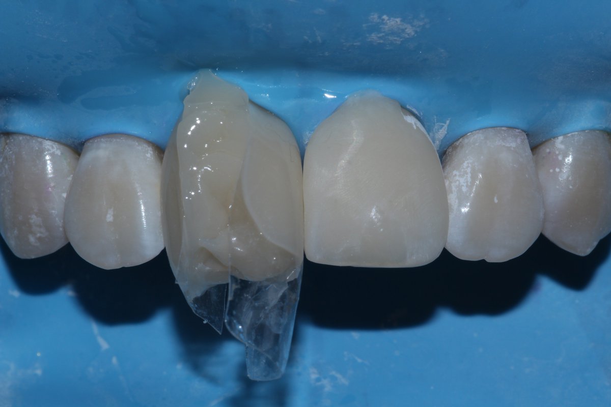 Dominic_Hassall's tweet image. Bioclear Case Study by Dr Claire Burgess - Black Triangle Closure after Invisalign treatment
Looking great on his 12-month review - great shine,
natural-looking, healthy gingivae and papillae reformation! 
Happy patient and dentist. 😁☺️

#bioclearmethod
#bioclear
#Dentist