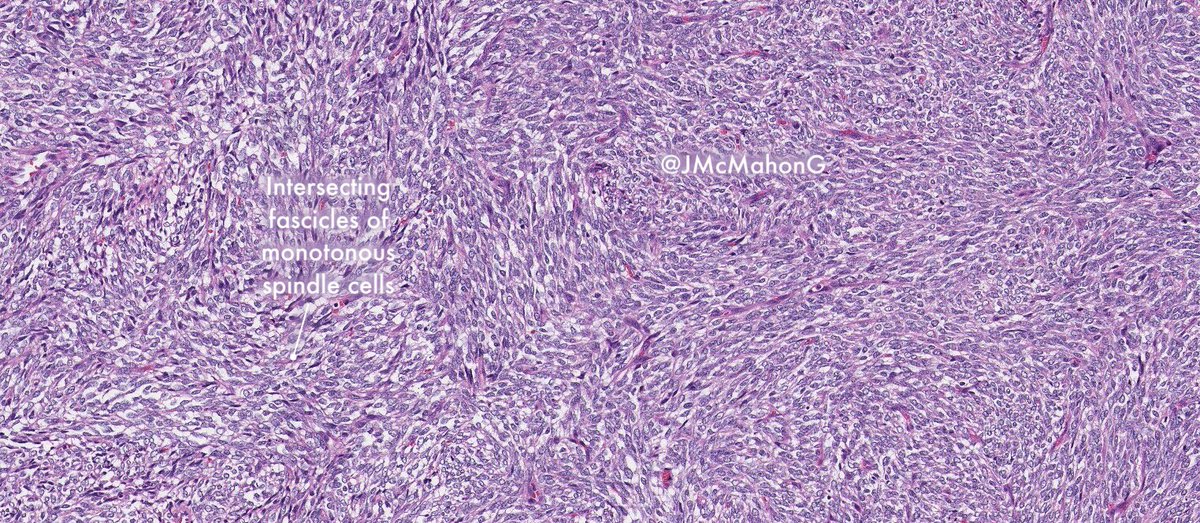 JMcMahonG's tweet photo. BCOR-REARRANGED ROUND CELL SARCOMA: This case with MC fusion, BCOR-CCNB3, paracentric inversion chromosome X(p11) via RNA seq. Mostly in bones, young boys. Sheets + intersecting fascicles of monomorphic round/ovoid cells + spindling often with whorling reminiscent of SS. #BSTPath https://t.co/1NYtrLUYyT