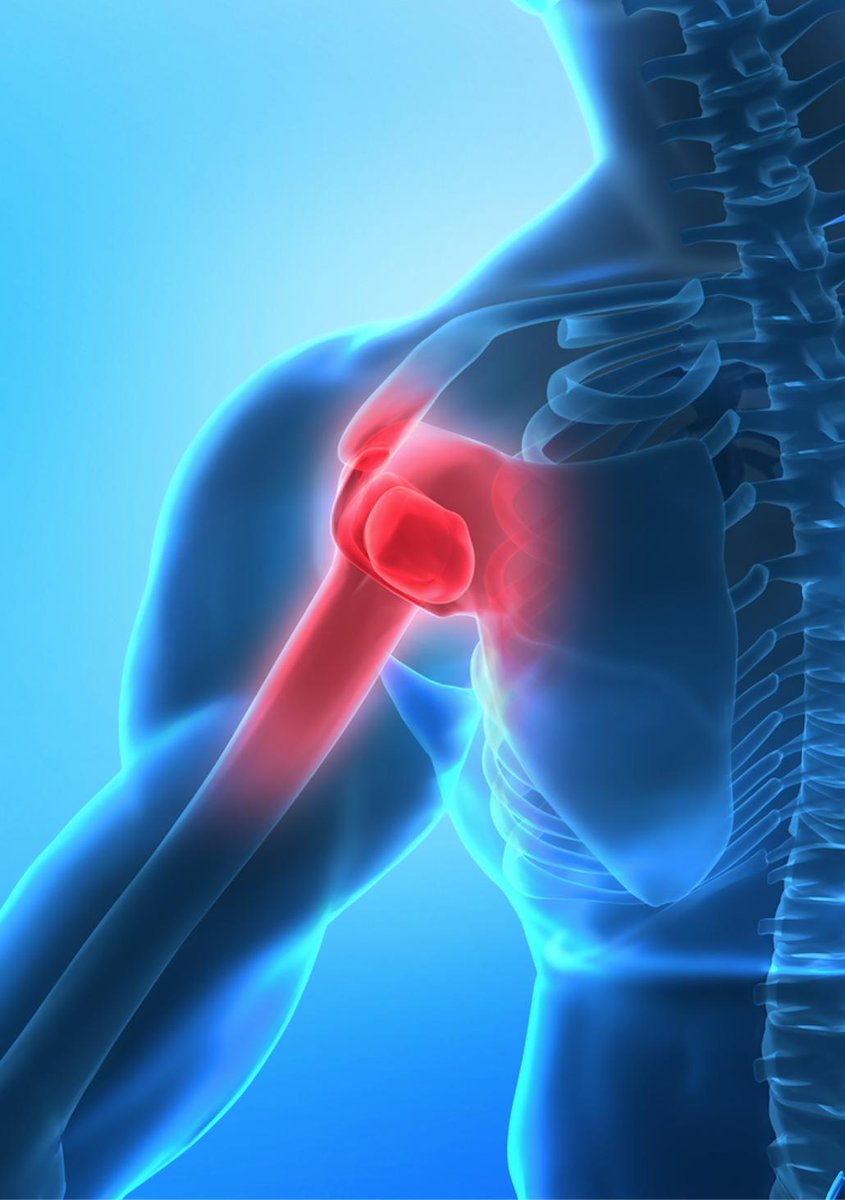 Flazzaraville's tweet photo. #ShoulderArthroscopySurgery uses a tiny camera called an #arthroscope which is placed inside a small incision in the #shoulder. Small, thin surgical instruments are also used to examine and repair the torn rotator tissues inside the #shoulderjoint
https://t.co/SN4cs1fHPT https://t.co/u2GjmuPH4u