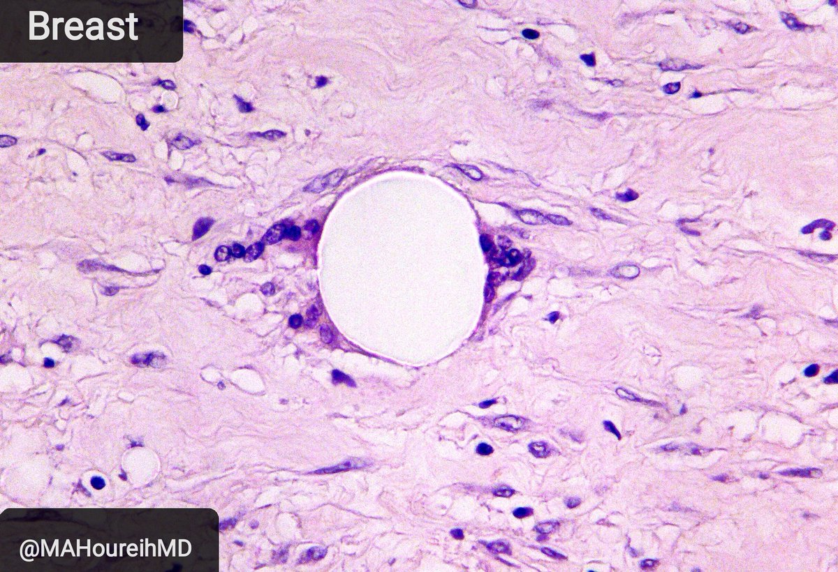 MAHoureih's tweet photo. #hemepath โก๏ธ #breatpath. Adult. Female. Axillary Lymphadenopathy + Later on breast tissue bx. #silicone_lymphadenopathy. @TheISBP @EdiBrogi @KhouryThaer @LizaMQuintana @kriyer68 @Chucktowndoc @dr_MPrieto @AtikankulTaywin @GeryVB @DrRolaAli @tralimiguel @PathologySayah @BinXu16 https://t.co/WXRcmX7KTe