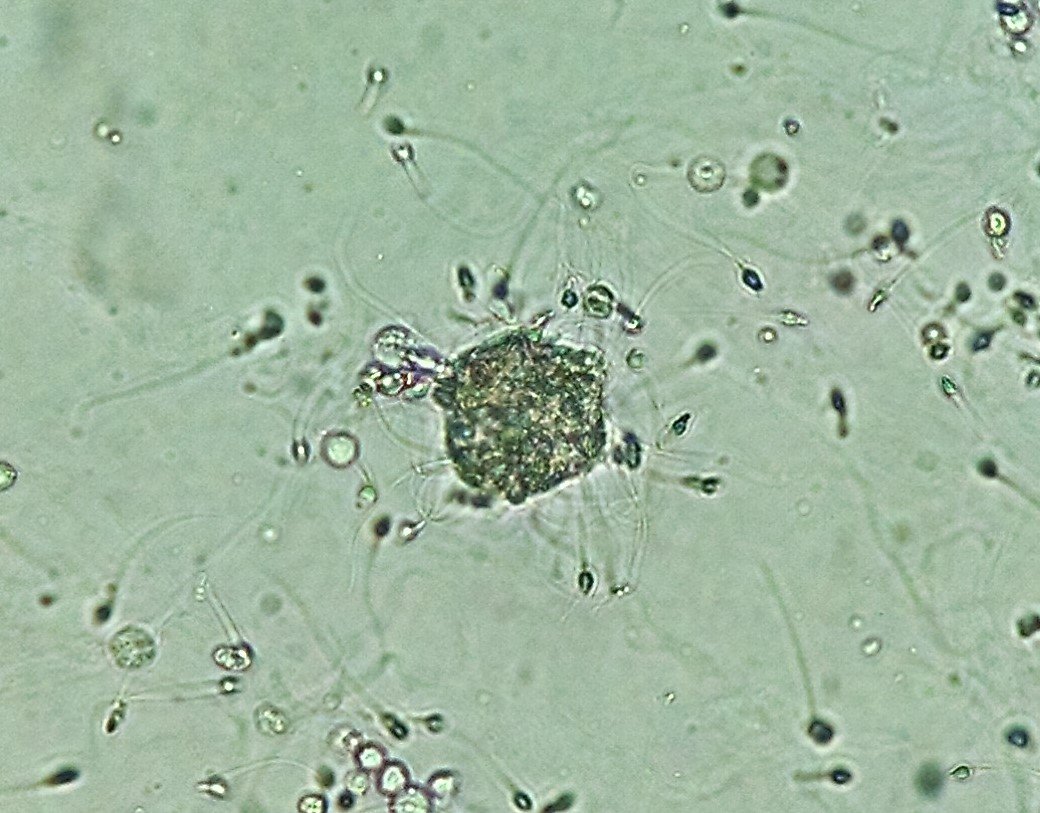 macrophage in urine sediment