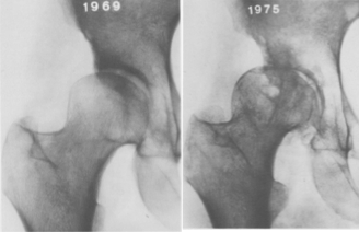 StephaniePunMD's tweet photo. #HipDysplasia is broadly defined as a shallow acetabulum that does not sufficiently cover the femoral head, resulting in damage to the joint and arthritis over time. Up to 50% of young arthritic hips can be attributed to underlying hip dysplasia (Clohisy et al, JBJS 2011) https://t.co/wvtv1365yN