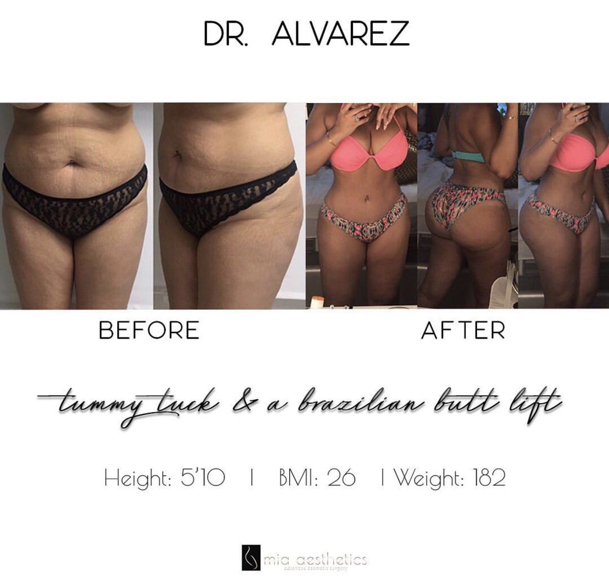 Mia_Aesthetics's tweet photo. #beautiful #TransformationTuesday #Goals #DrAlvarez #miamiplasticsurgeon https://t.co/Gk3YfP3C13