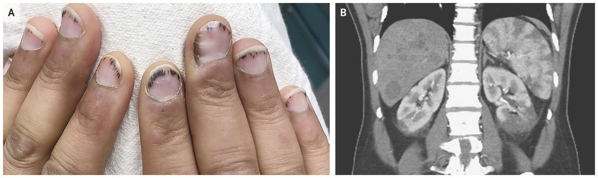 NEJM's tweet photo. Image of the Week: Nonbacterial Thrombotic Endocarditis https://t.co/FMrznQ6Wry https://t.co/Neiy1eeKIu