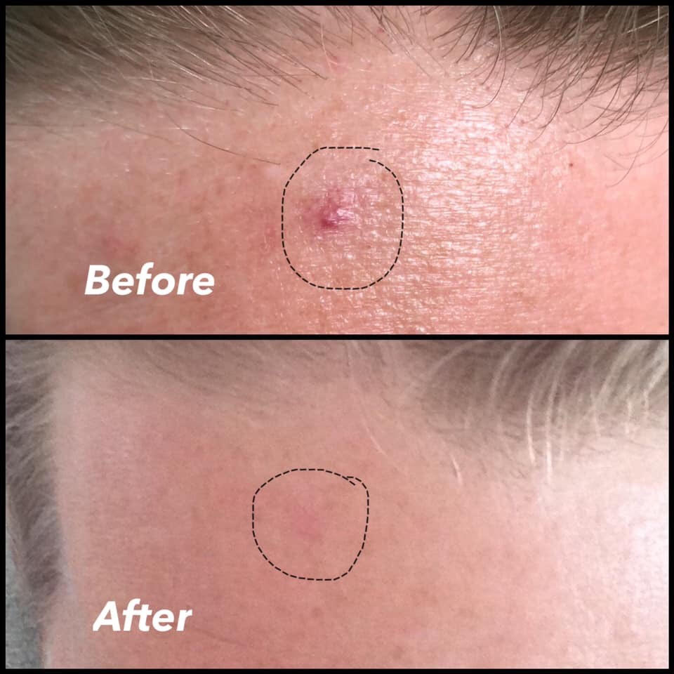 Our laser machine can even diminish a cherry angioma (mole like skin growth)!
