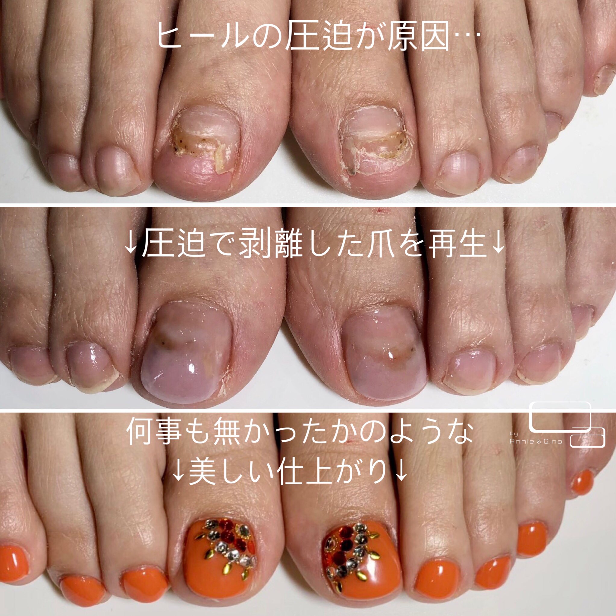 ネイルサロン Annie Gino 在 Twitter 上 圧迫で剥離してしまったお爪も再生可能です ぜひ ご相談ください 最新夏デザインは コチラ T Co Ymzl2zyggn 爪再生 爪 スカルプ 剥離 爪剥離 フットジェル ハイヒール 阿波踊り よさこい 高知 徳島