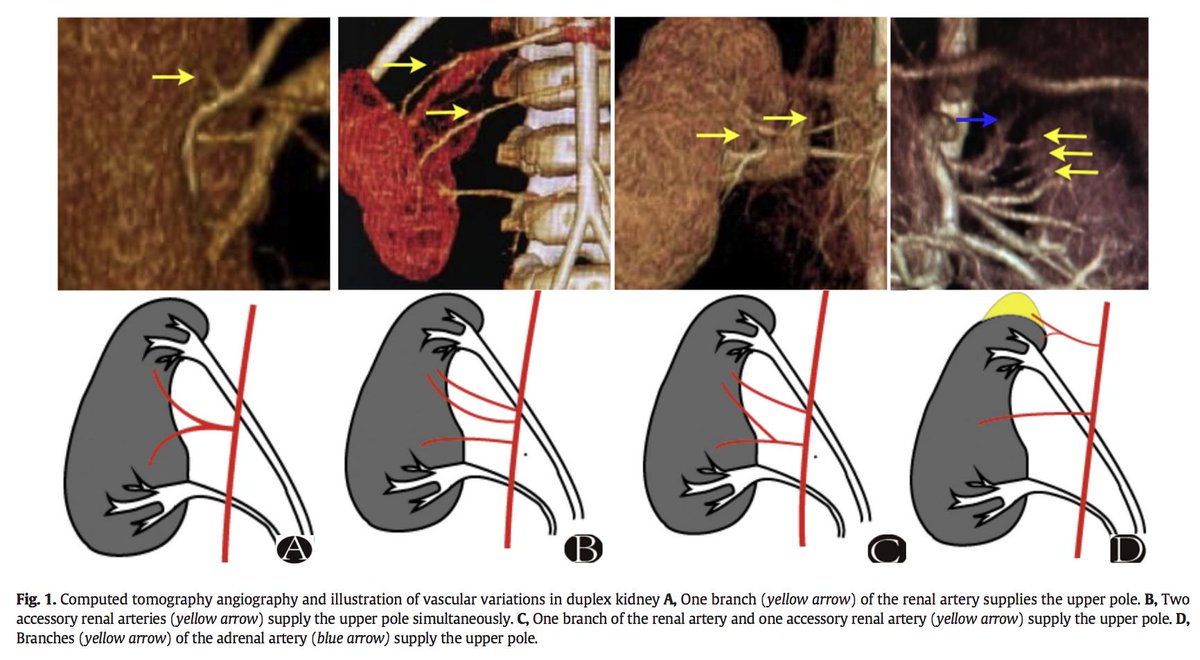 jpedsurg's tweet photo. Anatomy and management of upper moiety vascular variation in children with duplex kidney https://t.co/TSbyUQ21zB #jpedsurg #PediatricSurgery #Retrospectivecohortstudy #Laparoscopicsurgery #Duplexkidney #LUPPN https://t.co/JXxEuObWcY