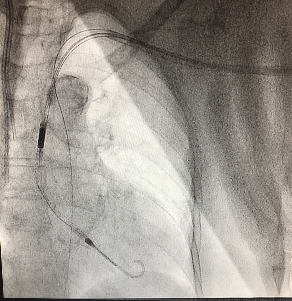 RajTayalMD's tweet image. After considering making an early transition to industry but struggling to walk away from the lab, damn it feels good to get the #CHIP train rolling again! 1st #PercAx LM #rotapro in NJ &amp;amp; single #safefemoral access with 7fr dest via CP. Off-label but 💯! Props to @jason_wollmuth