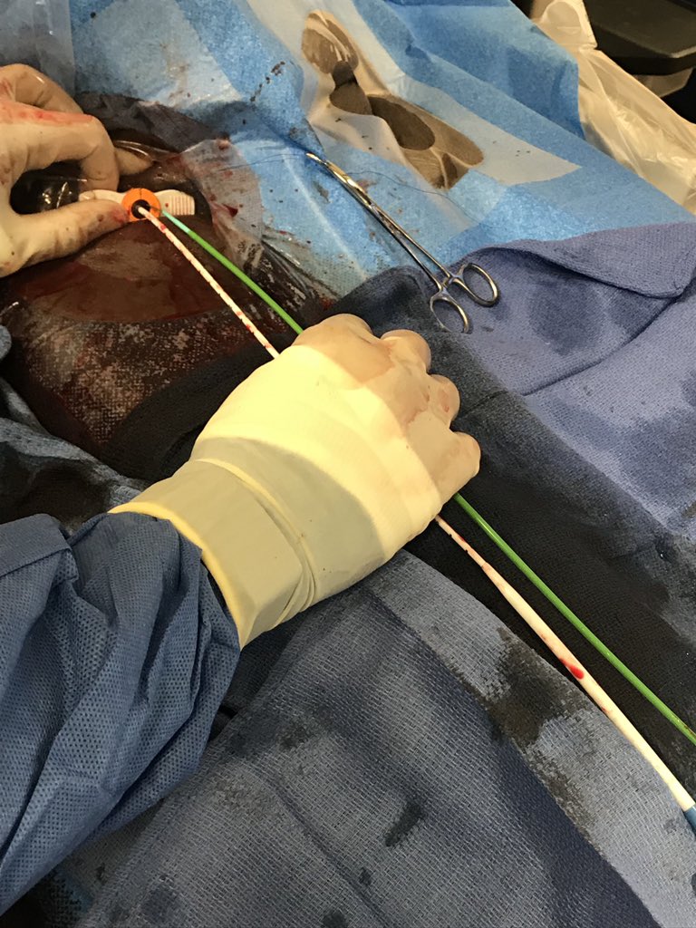 RajTayalMD's tweet image. After considering making an early transition to industry but struggling to walk away from the lab, damn it feels good to get the #CHIP train rolling again! 1st #PercAx LM #rotapro in NJ &amp;amp; single #safefemoral access with 7fr dest via CP. Off-label but 💯! Props to @jason_wollmuth