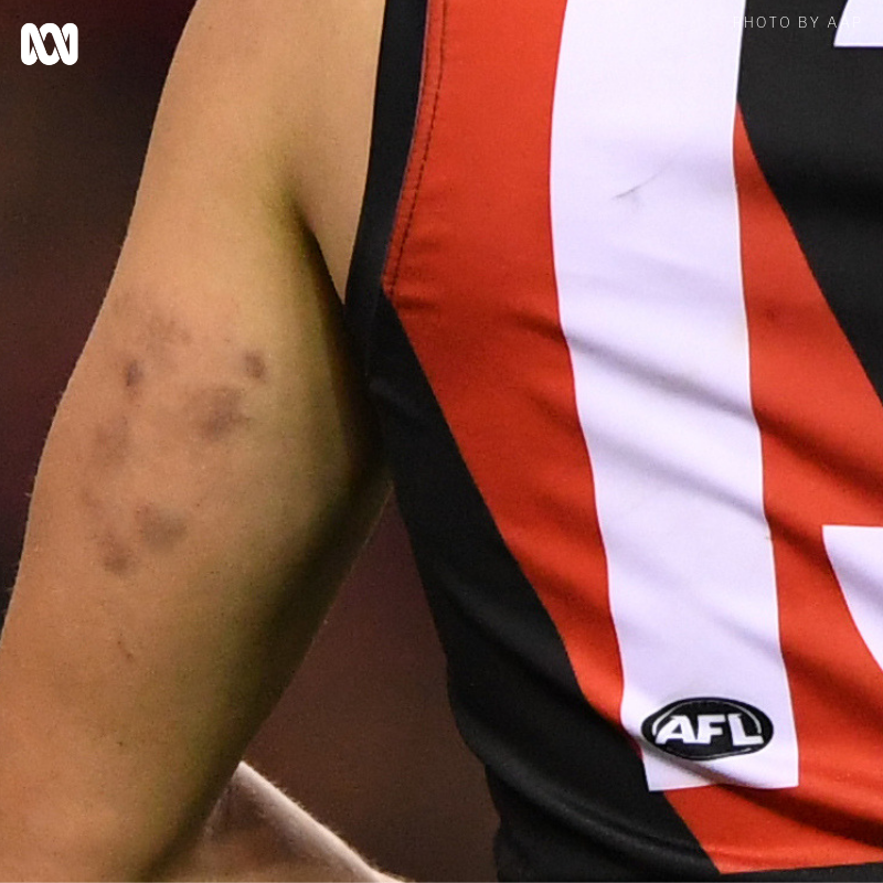MJ_SCTalk's tweet photo. Hope the @AFL comes down hard on Ben Stratton’s disgraceful pinching tactics. Disappointing the @7AFL commentators endorsed his behaviour as a legitimate defensive tactic within the rules. Not a good look for young girls and boys who will give it a go this weekend. #AFLDonsHawks https://t.co/QbdiYvdNCN