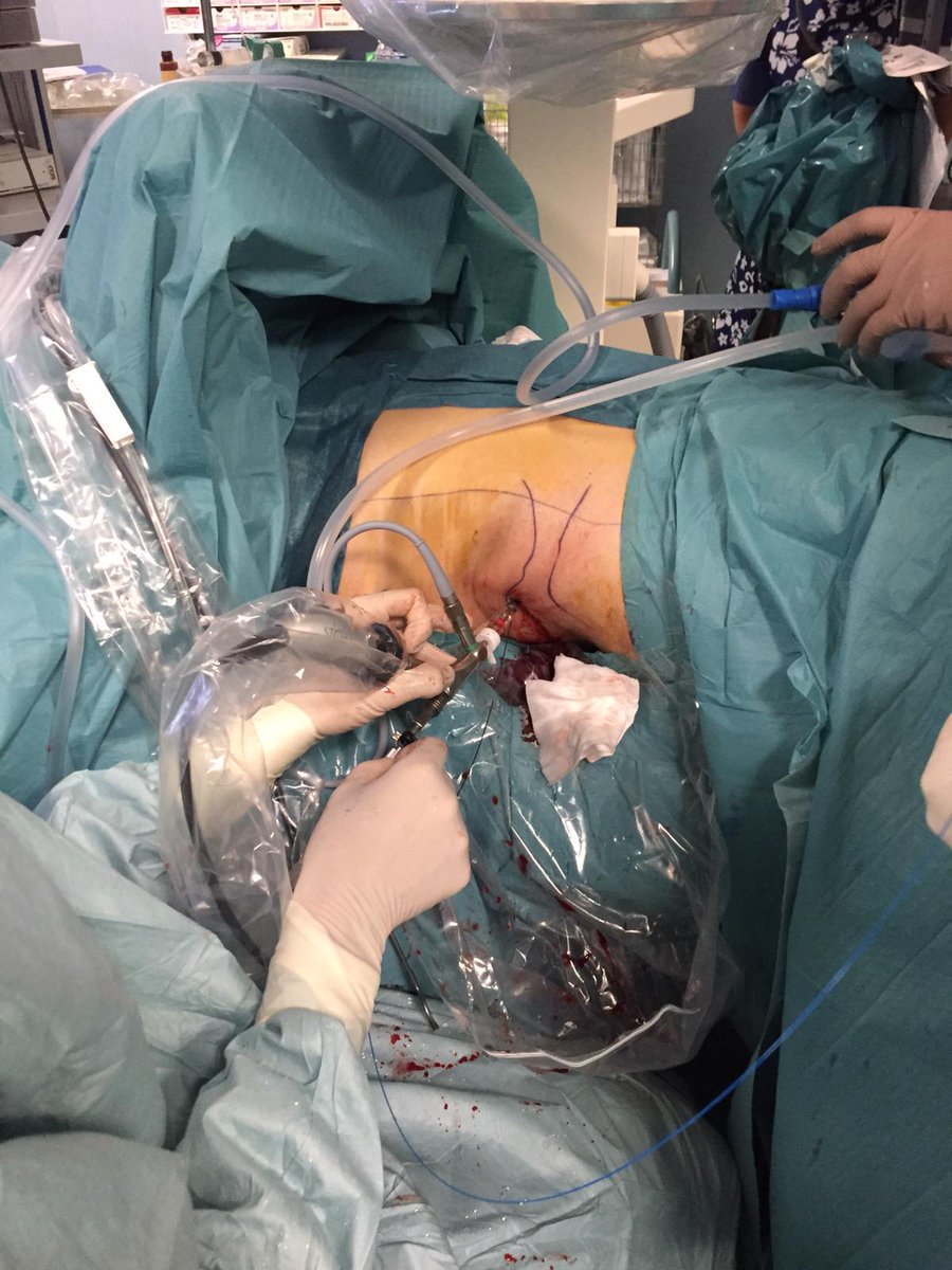 Il nostro ClearPetra fa notizia❗️
✅Operazioni eseguite con successo all'ospedale di Savigliano (CN)
Calcoli di 3cm eliminati con l'innovativo sistema ad aspirazione continuo <a href="/JustineShi_js/">@ClearPetra-Well Lead</a> 

Leggi l'articolo👉bit.ly/2ReS8uN

#medicalinnovation #endourologia