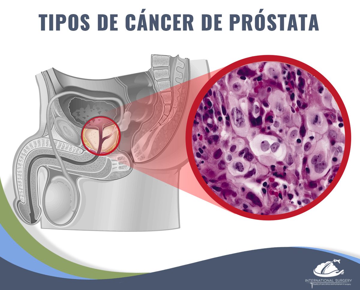 Cancer de prostata en pacientes jovenes