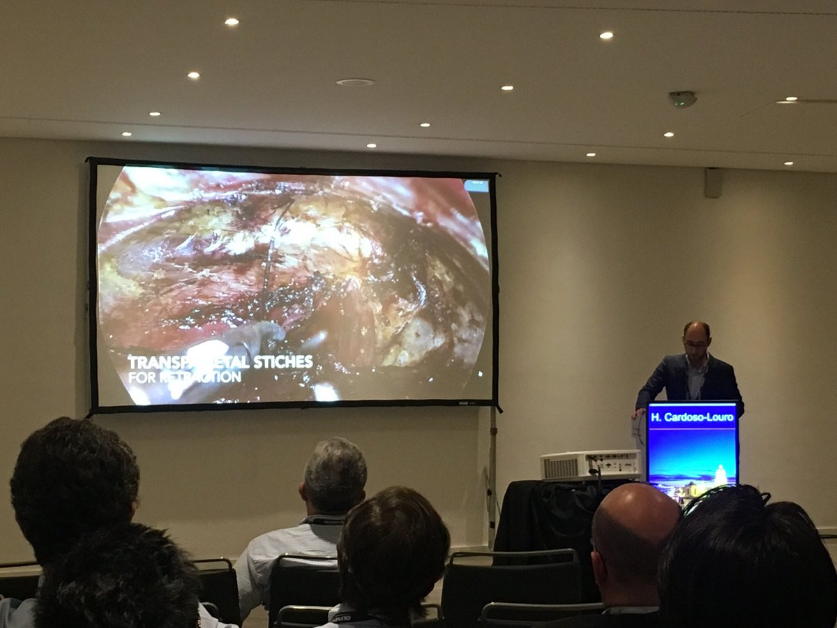 JGMAzevedo's tweet photo. Great technique and different approach to a Zenker Diverticulum, #transaxillary @CardosoLouro https://t.co/O67bMijTA3