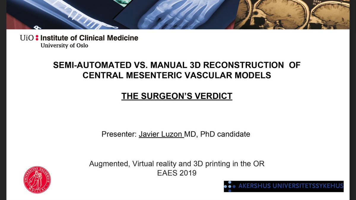 JavierLuzonMD's tweet photo. 3D anatomical models are important for surgeons. We also have to make sure they are produced correctly.
Yes to our digital twins! But identical twins! Thanks #EAES2019 @EAES_eu  @UniOslo_MED @Ahus_no #3dmodels #mesentery #digitalsurgery @me4_so #PrecisionMedicine https://t.co/AmDpltOMog