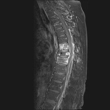 atmghn's tweet photo. don’t waste time! 
it’s about surviving a deadly infection, about preservation of
walking ability, bladder/bowel control, autonomy, sexual function, quality of life...
no matter how late in the evening/night - there is no excuse for delay

#EpiduralAbscess 👉 spine surgery https://t.co/3bOC8sRyjc
