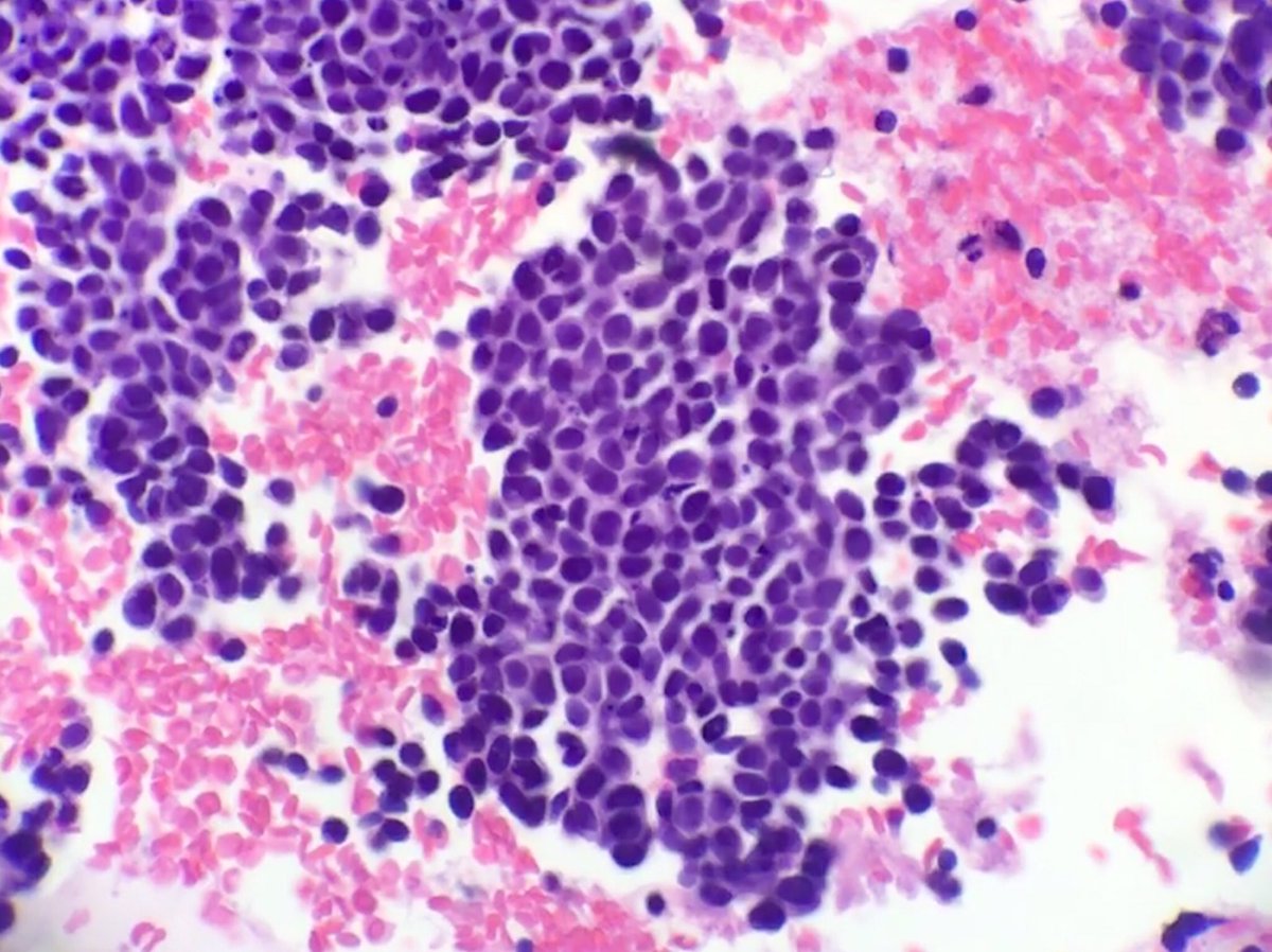Aimi T Rothrock Md On Twitter Day 35 Merkel Cell Carcinoma On Cytology Cd56 And Nse Are More Likely To Be Positive Compared To Synapto And Chromo Cytopath Pathology Learningeveryday Https T Co Y2h1iz3jdw