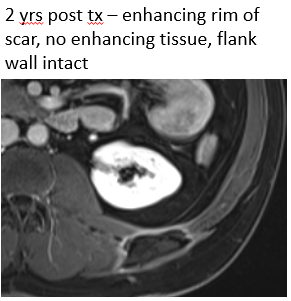 5cm #desmoid tumor in left flank underwent resection. After 1 yr, regrew to 6cm (v aggressive). Multiple medical therapies, grew to 8cm. Referred to IR – treated with particle #embo + #cryoablation. Disease free at 2 yrs! <a href="/SIRRFS/">SIR RFS</a> @BTGIO <a href="/SIRspecialists/">Society of Interventional Radiology</a>