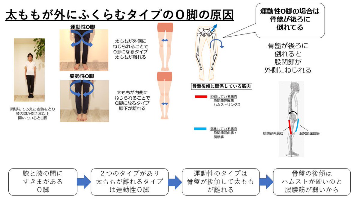 理学療法士キリツ 姿勢良くする人 O脚の原因を知らないと 治せませんよ 膝が離れるo脚は 膝が痛くなる 足が太くなる 足が短く見える など悪いことばかり このo脚には2パターンあって 太ももがふくらんでなるタイプ 膝下がふくらんでなるタイプ