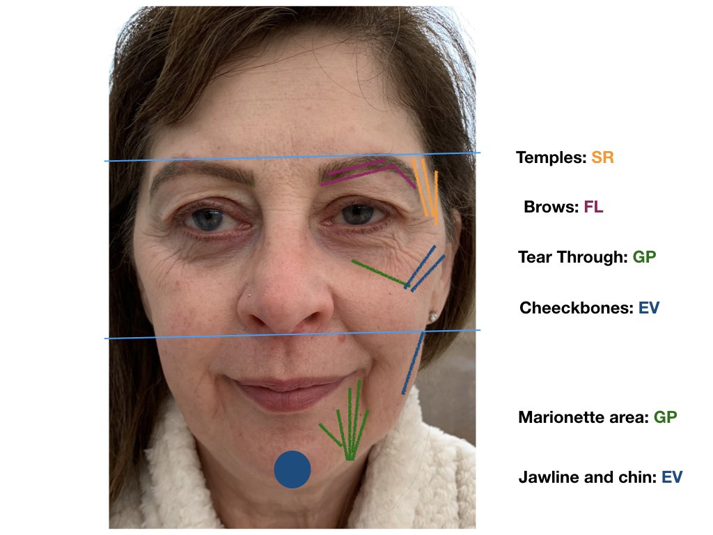 Training on prevention of #complications with Mr Ansar Mahmood and <a href="/DrBeatrizMolina/">Dr Beatriz Molina</a>  <a href="/Medikas1/">Medikas</a> <a href="/KeeleUniversity/">Keele University 🐿️</a> <a href="/aesthetics/">ً</a> <a href="/ha_dermauk/">HA-Derma</a> <a href="/profhilo_uk/">Profhilo</a> <a href="/aliaxinn/">ali axin</a>