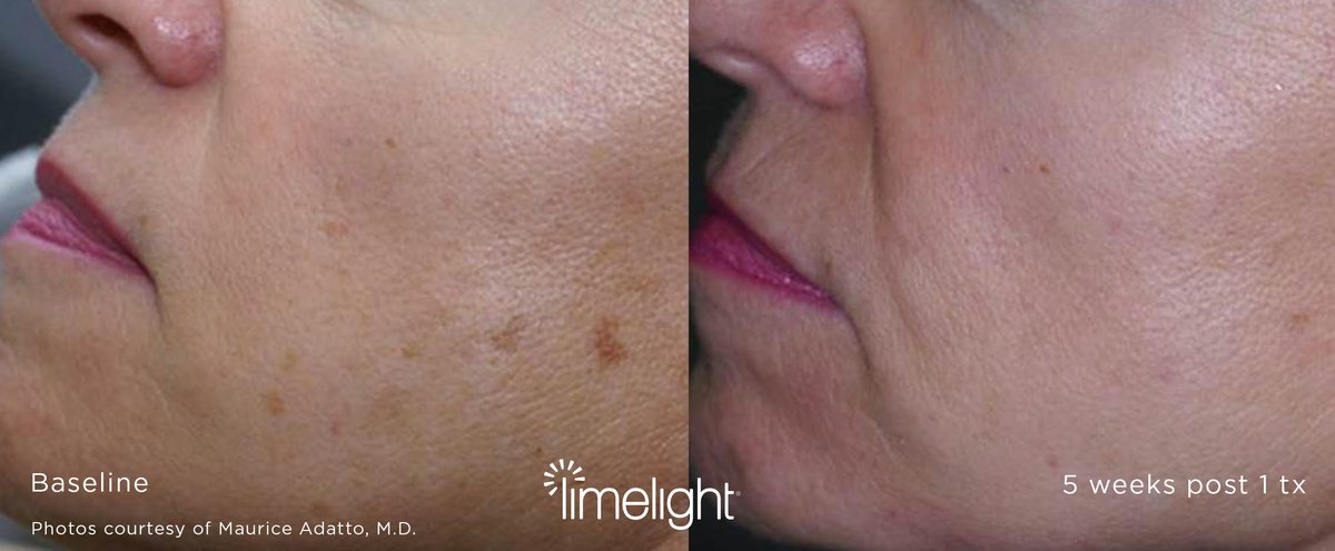 Do you see sun and age spots on your skin? A limelight treatment can erase the damage and leave your skin looking and feeling younger!