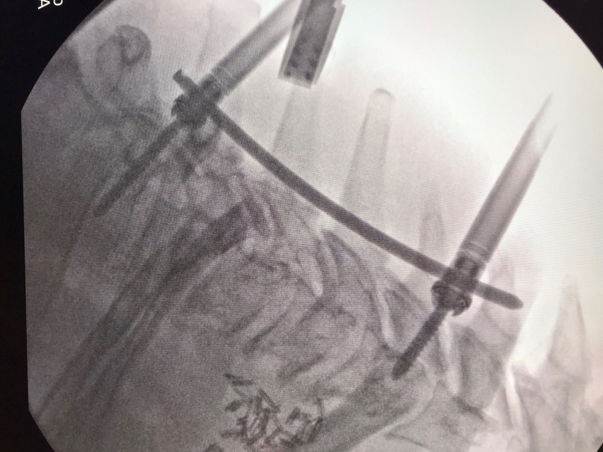 SpineWaveInc's tweet photo. Posterior Cervical Reimagined Another Proficient MIS lab in Charlotte, NC
#Cervical #MIS #Charlotte #Proficient #SpineWave https://t.co/EOVBPas9nm