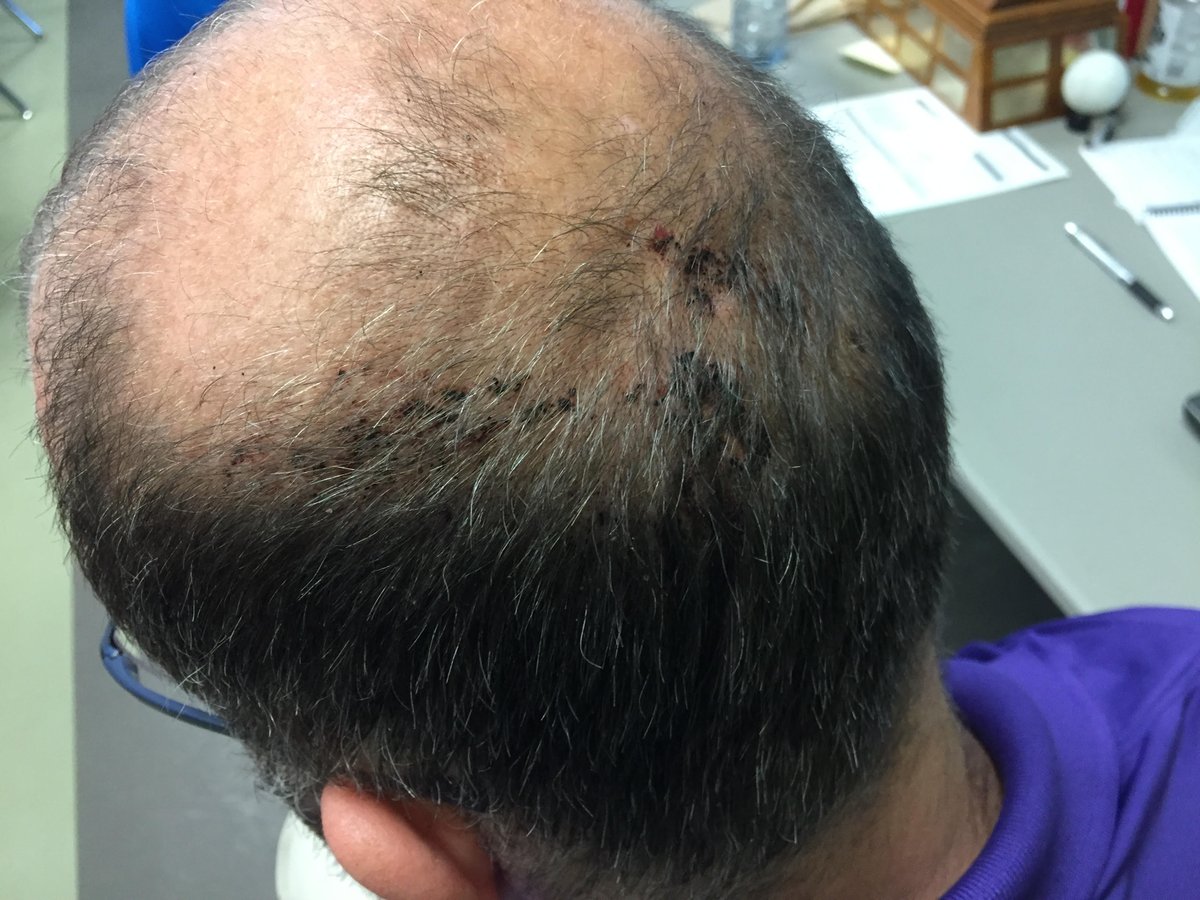 OLOA (@oloaofficial) on Twitter photo Last night, a referee was heinously assaulted by @Innisfillax coach Dwayne Palomaki at an <a href="/OntarioLacrosse/">Ontario Lacrosse</a> game. He was left bloodied and with facial trauma requiring hospitalization. Thoughts? #norefsnogame #changethegame #stoptheabuse Last night, a referee was heinously assaulted by @Innisfillax coach Dwayne Palomaki at an <a href="/OntarioLacrosse/">Ontario Lacrosse</a> game. He was left bloodied and with facial trauma requiring hospitalization. Thoughts? #norefsnogame #changethegame #stoptheabuse