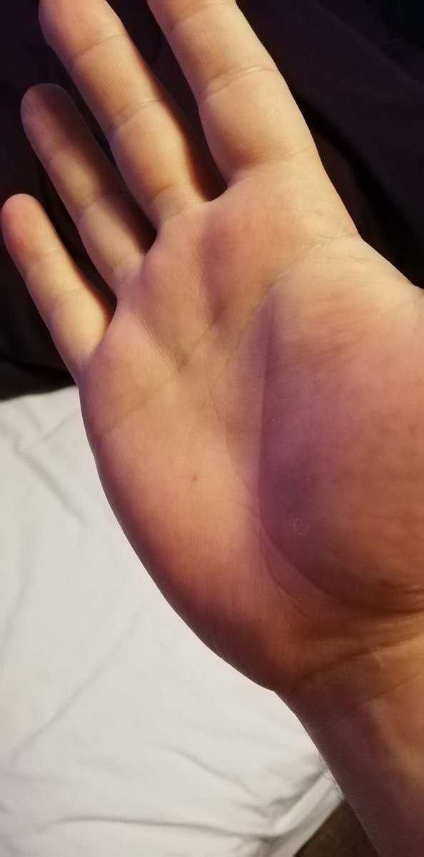 REF_JumpingJohn's tweet image. Counting hands and thumbtacks don't mix. ✋#RefClub