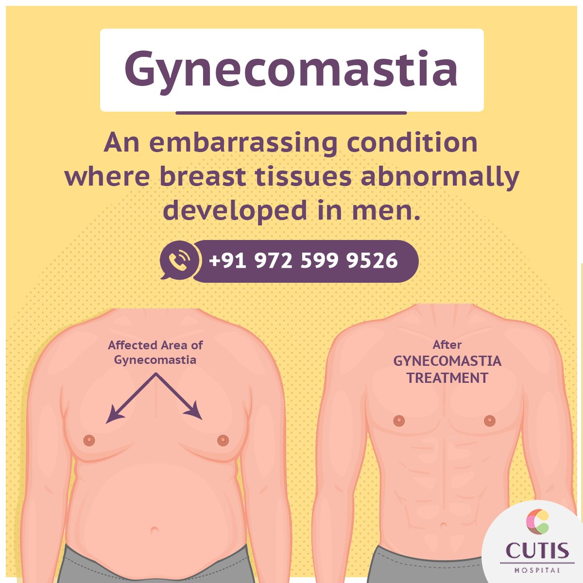 CutisHospital's tweet photo. #Gynecomastia is one of the conditions where men feel disappointed ashamed. We @CutisHospital help you gain your confidence back by flattening your chest with #MaleBreastReductionSurgery. Share your queries at +91 972 599 9526
#GynecomastiaSurgery #CutisHospital #Ahmedabad https://t.co/OJaVhnAVji
