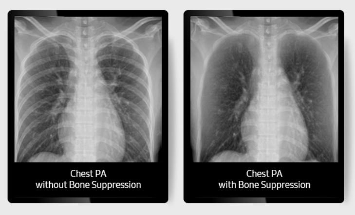 samsunghcusa's tweet photo. Bone Suppression technology in our #GC85A #DigitalRadiography machine improves clarity of soft tissues by suppressing the appearance of bones in chest images, improving the ability to detect nodules.
Learn more: https://t.co/HkiHXEbGzj https://t.co/FqNVvO5VSP