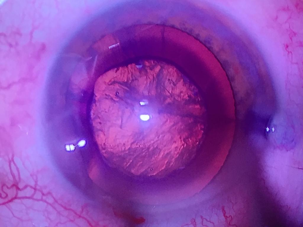 IMEXonline's tweet photo. Capsulotomías perfectas con #capsulaser ⭕️ 
Haz más precisa tu práctica manual.
https://t.co/yDlD7wSfrN https://t.co/QigExCdtQ4