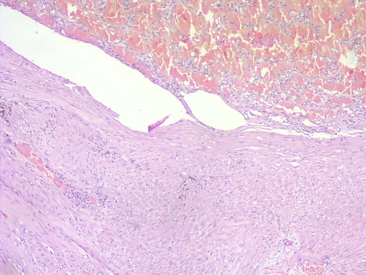 ariella8's tweet photo. #GUPath #FAQpathstage  8 cm clear RCC .This is a pic of sinus fat .Your thoughts appreciated 😊🙏would you agree on stage 3a? https://t.co/Sz79dXF81Y