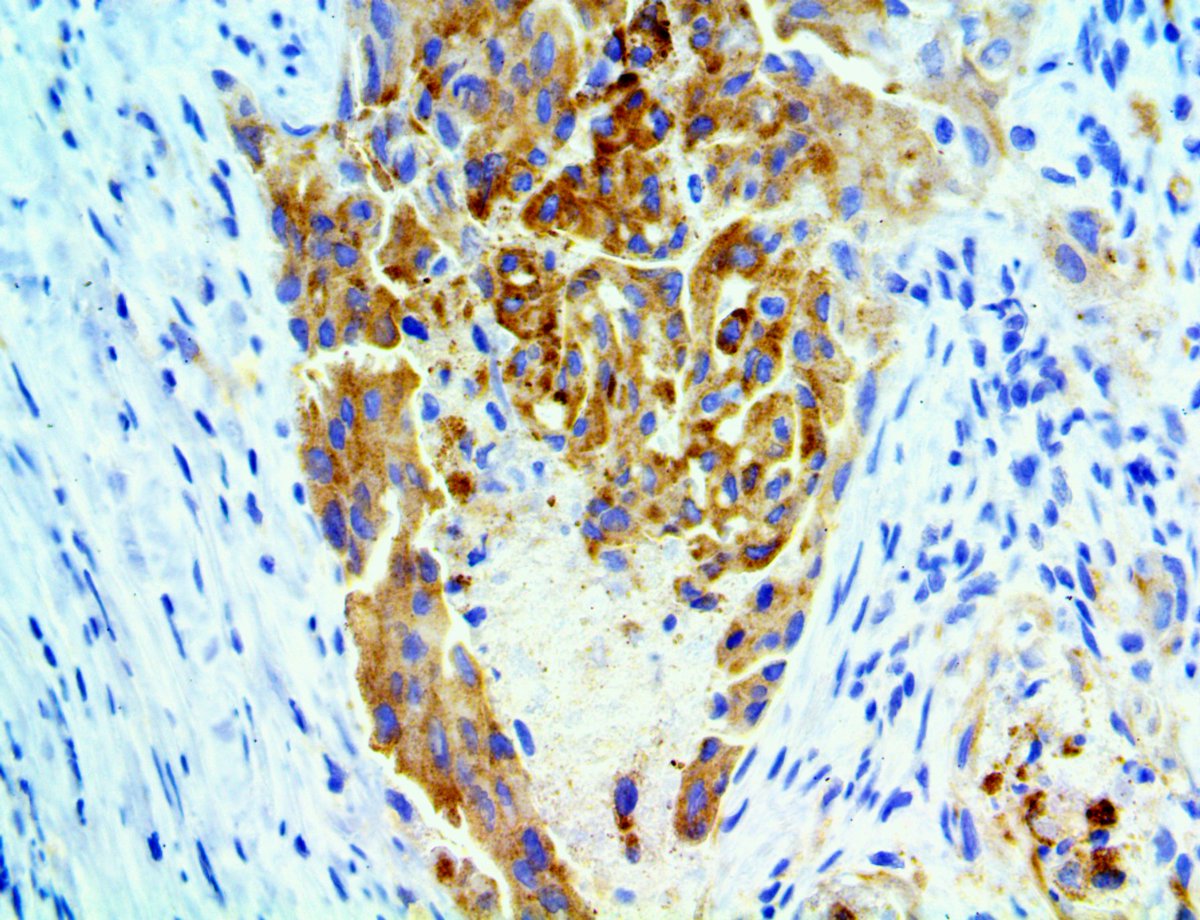 Bio_SB's tweet photo. Great image of our NEW NEW ROS1, #RMab, on non-small cell lung cancer (NSCLC) tissue. Multiple studies have demonstrated its occurrence in lung cancers, making itpopular for use in NSCLC diagnosis. https://t.co/R6aDP5Ik2l
#IHC #pathology #pathology #pathart #IHC #pathologist https://t.co/pU9Lrx9o7W